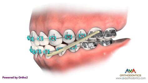 underbite metal bracket rubber bands|rubber bands for underbite.